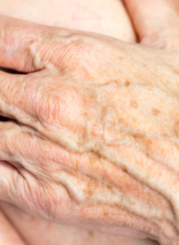 揭秘老年斑的真相!營養、護理與防曬的秘訣大公開