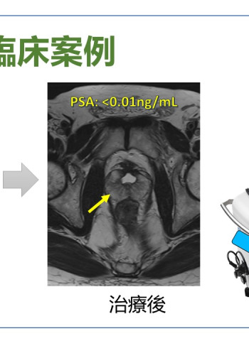 奇美醫院海福刀無創手術 結合即時影像 精準摧毀癌細胞